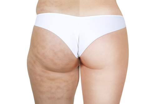 Complete Guide to Understanding and Treating Cellulite
